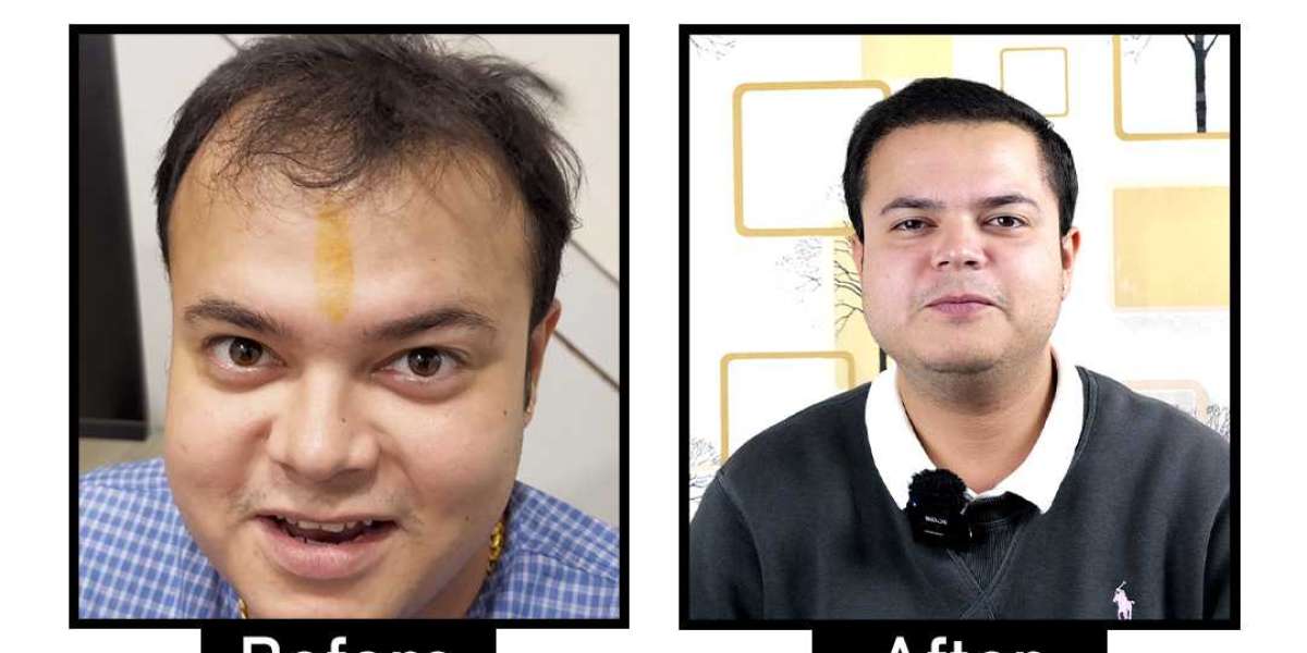 Best Hair Loss Treatments in Delhi: PRP, FUE